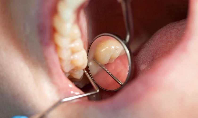 Mantenimiento periodontal - Revisión