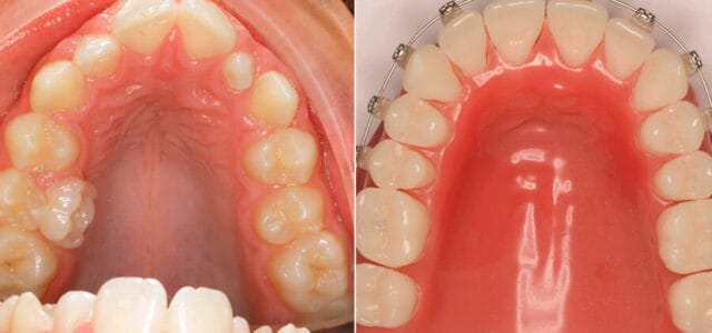 antes y después del interruptor de protección dental