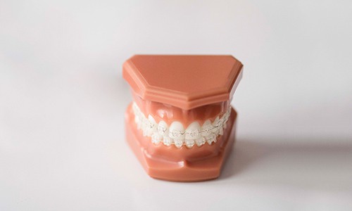Precio por tratamiento de ortodoncia con brackets transparentes