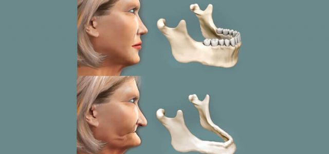 La pérdida de dientes conduce a la pérdida ósea