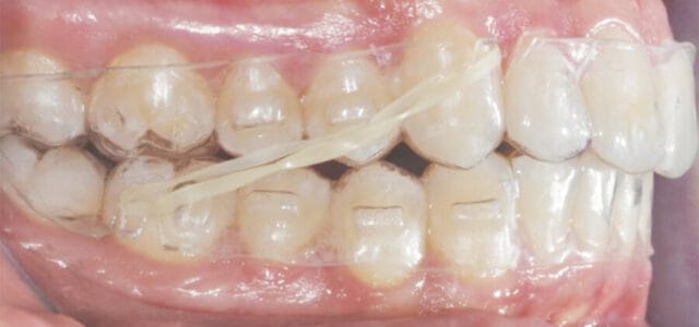 Goma de ortodoncia Invisalign