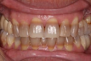 Tratamiento blanqueador de dientes con tetraciclina