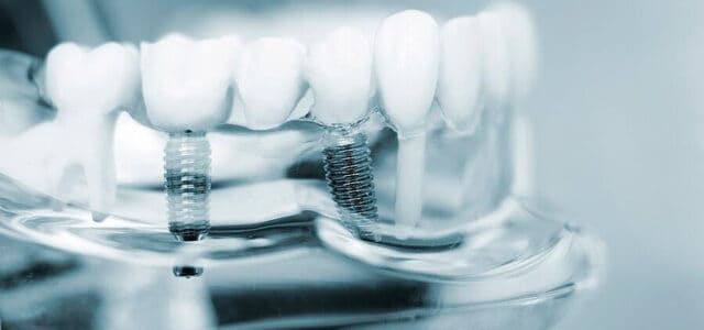 dientes implantados