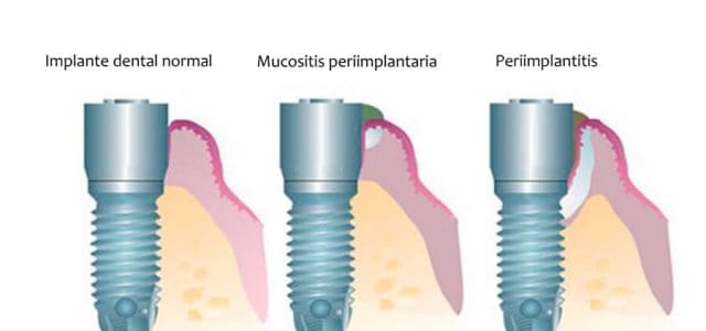 Mucositis periimplantaria