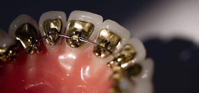 brackets en los dientes