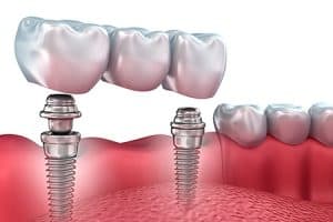 Puente dental sobre implante