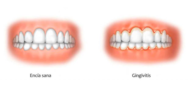 La gingivitis puede irritar las encías.