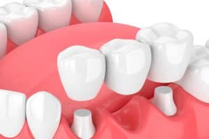 Puentes dentales sobredienes