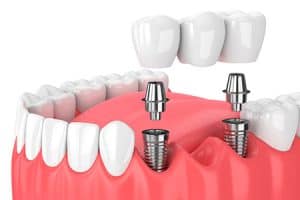 Puentes dentales sobre implantes