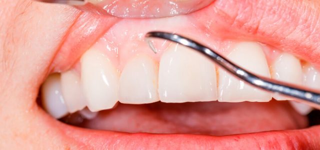 Tratamiento contra la periodontitis
