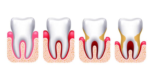 Avance de la periodontitis