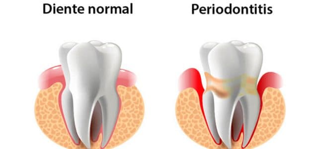 Encia con periodontitis